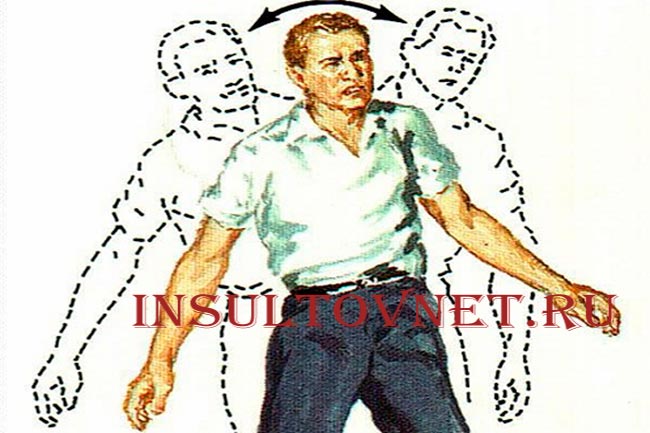 Мозжечковая атаксия