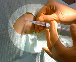 Укол Местный наркоз