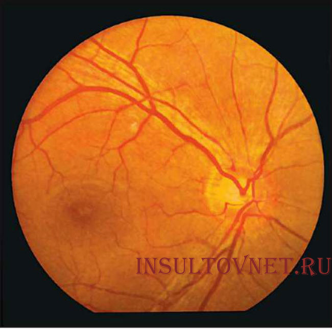 Глазное дно после инсульта