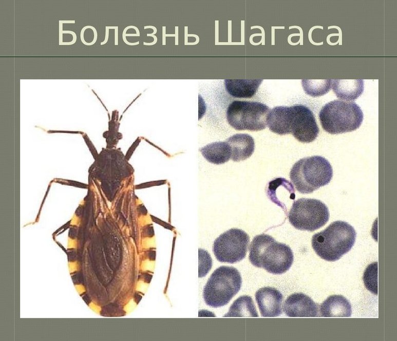 Болезнь Шагаса