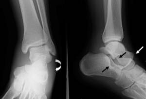 Рентген стопы Снимок ноги