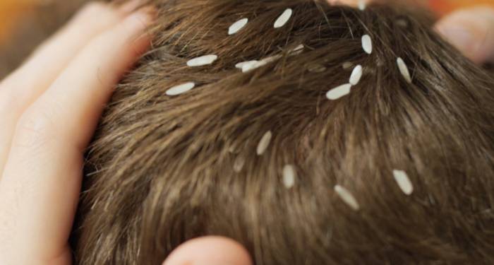 Вши и гниды у ребенка