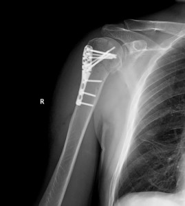 Остеосинтез шейки плеча Фиксация костных отломков