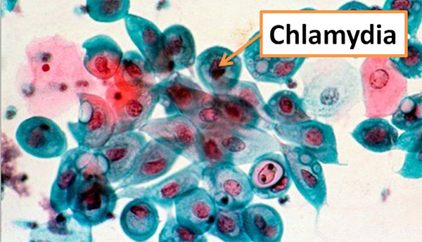хламидия трахоматис