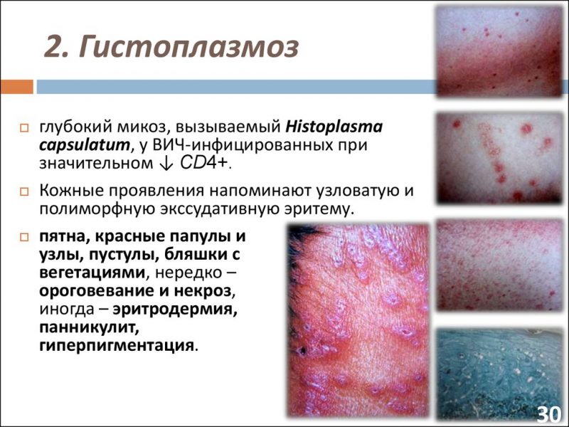 Гистоплазмоз