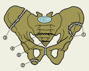 переломы тоза Краевые переломы тазовых костей