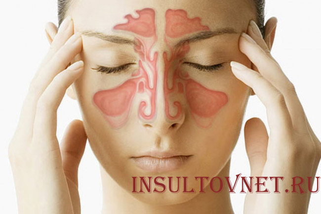 Болят уши при гайморите