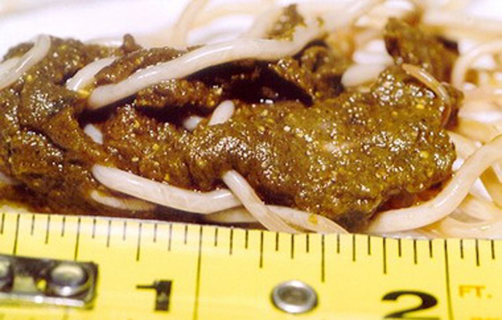 кал с глистами