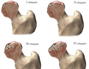 Стадии некроза Асептический некроз головки бедренной кости