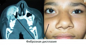 Фиброзная дисплазия Фиброзная дисплазия - это тяжелое последствие заболевания
