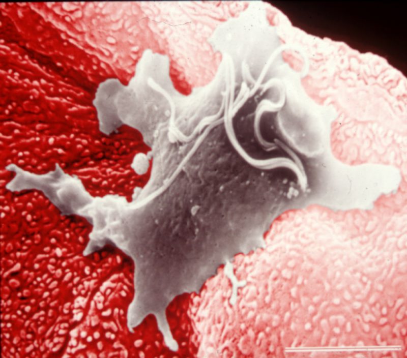 Что такое трихомониаз