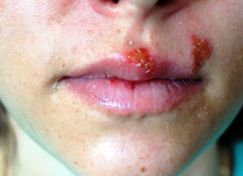 воспаления гнойного характера