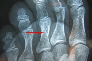 Ренген пальцев Перелом пальцев стопы