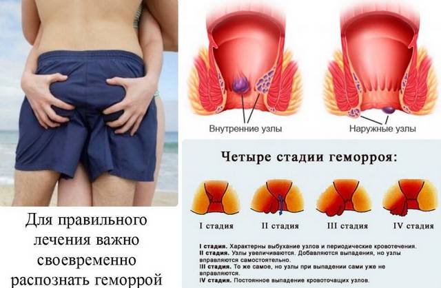 Первые признаки геморроя: как лечить