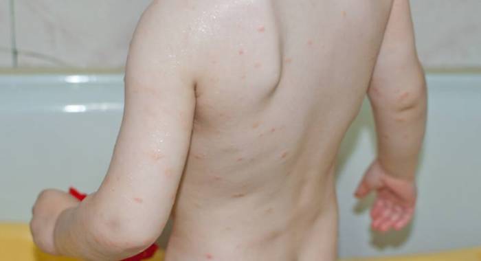 высыпания по телу