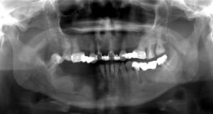 Рентген челюсти Главным методом диагностики является рентгенологическое исследование