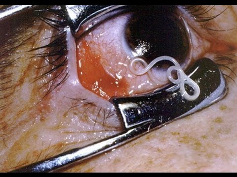 Лоа лоа Лоа лоа