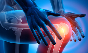 Вывих коленного сустава Смещение суставной поверхности одной кости по отношению к аналогичной поверхности другой