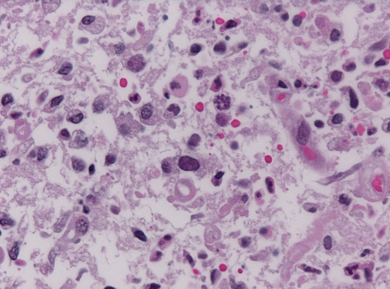 хронический токсоплазмоз во время беременности