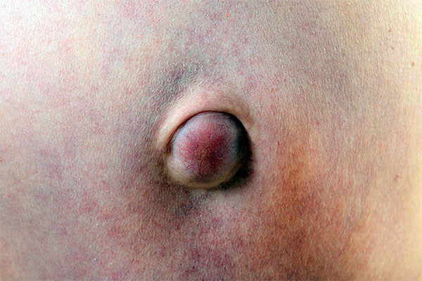 фото грыжа на животе у женщин