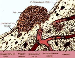 Саркома кости Рак кости