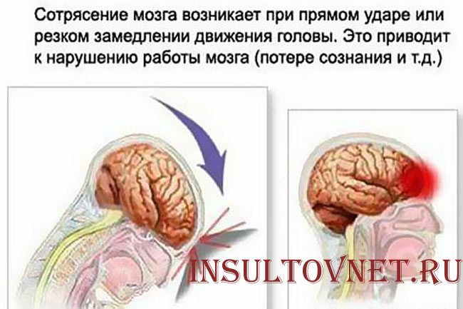 Признаки сотрясения мозга