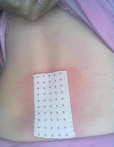 Использование пластыря Доктор Перец обезболивающего