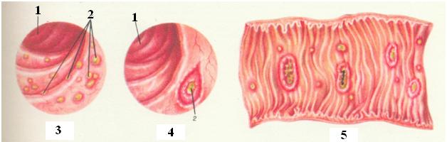 кишечный амебиаз