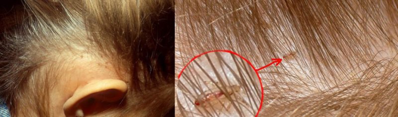 вши передвигаются по голове