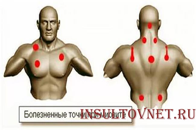 Шейный миозит