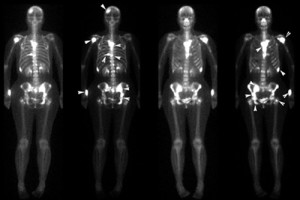 Скелет человека Сцинтиграфия костей скелета
