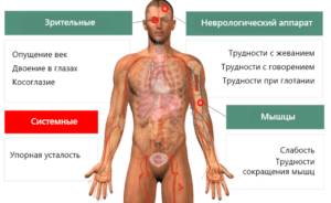 Симптомы миастении мышц