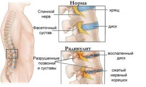 Схема радикулита и его симптомы