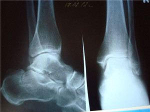 Ретнген пятки Рентген делается в двух проекциях