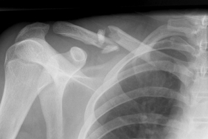 Рентген снимок Диагностика перелома ключицы с помощью рентгена