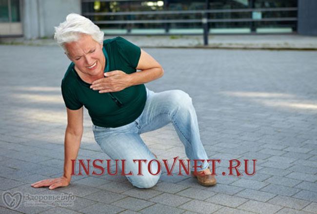 Признаки инсульта правой стороны