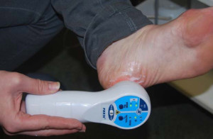 Лечение шпоры в пятке Лечение пяточной шпоры лазером