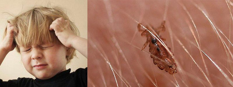 вши у детей фото