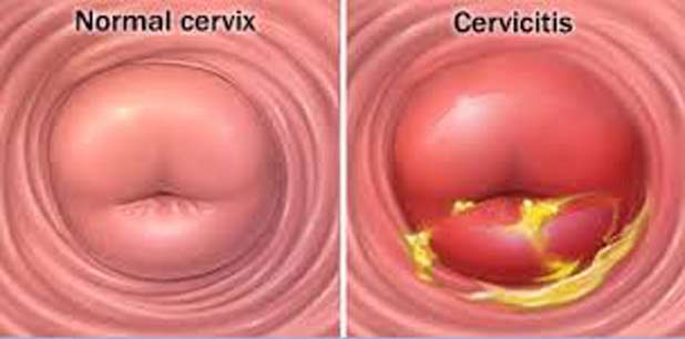 выделения при триппере