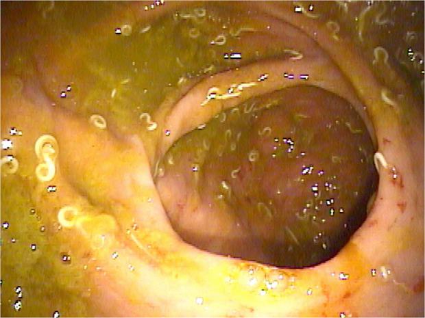 глисты под микроскопом