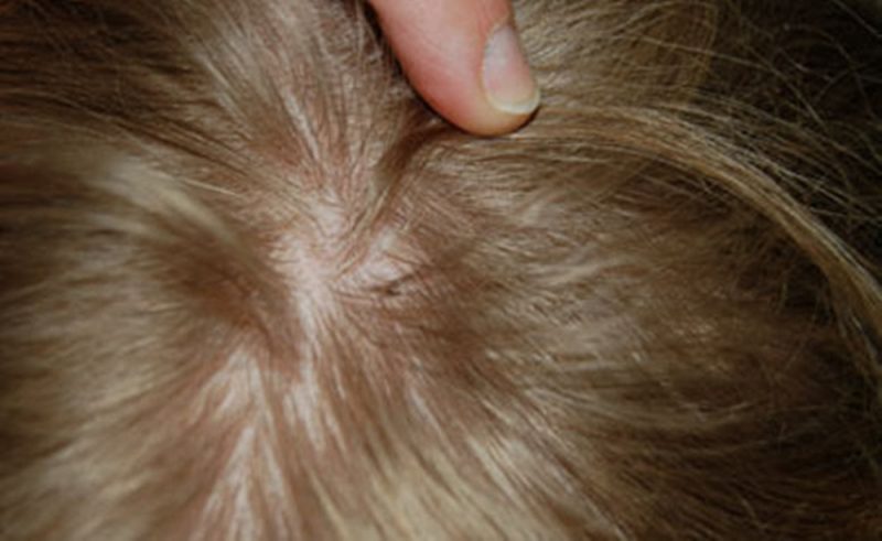 вши у ребенка