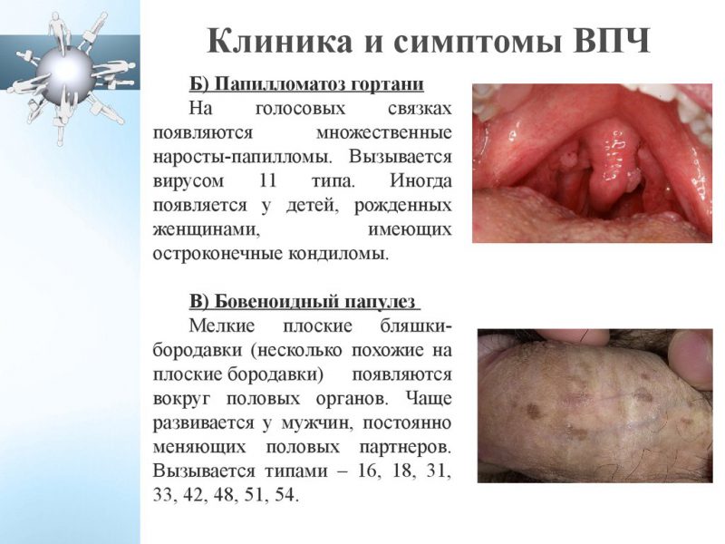 ВПЧ 16