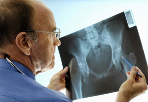 Врач смотрит рентген Мраморная болезнь