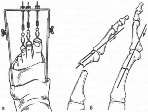 Скелетное вытяжение пальцев ноги Скелетное вытяжение при переломах костей стопы