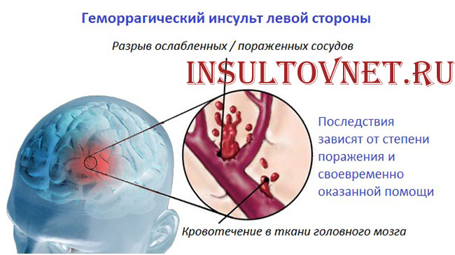 геморрагический инсульт