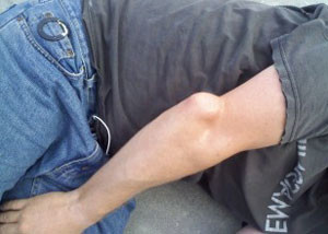 Перелом руки Перелом локтевого отростка