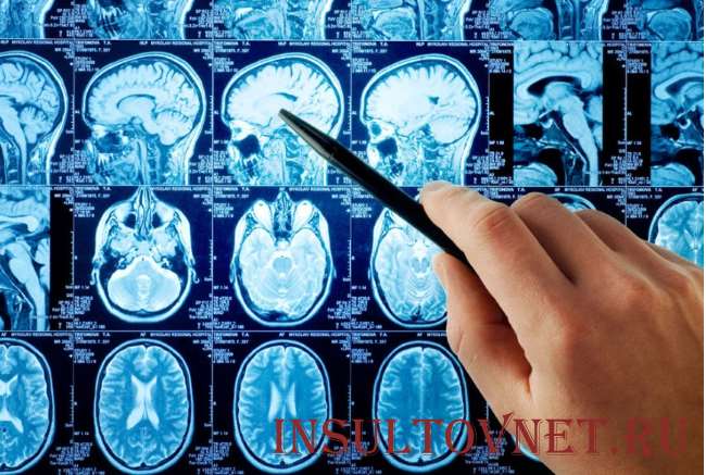 Геморрагический инсульт: что это