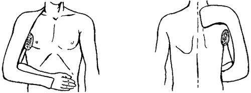 Гипсовая лонгета Турнера Иммобилизация руки с помощью гипсовой лонгеты Турнера