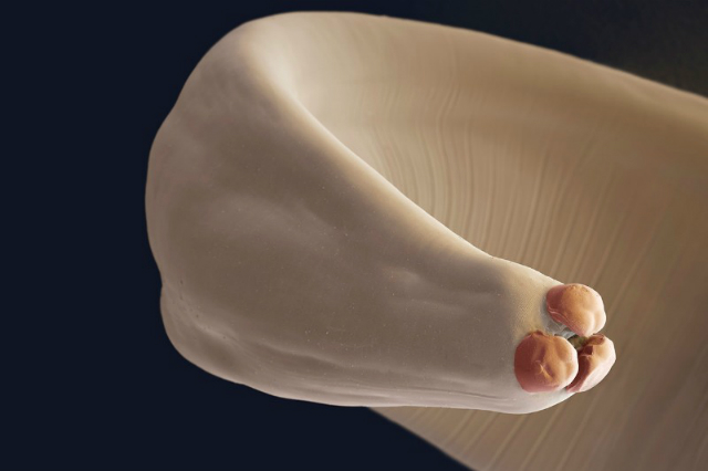 анкилостома