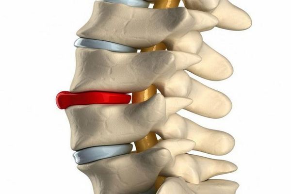 Как выглядит протрузия диска